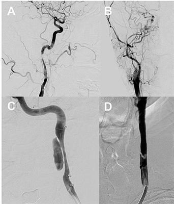 Clinical Outcomes of Endovascular Treatment for Carotid Artery Dissection Without Intracranial Large Vessel Occlusion in Patients With Cerebral Ischemia Presentation